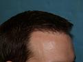 Click image for larger version

Name:	10 months post-op 020.jpg
Views:	290
Size:	41.3 KB
ID:	453437