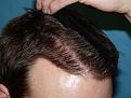 Click image for larger version

Name:	10 months post-op 050.jpg
Views:	297
Size:	61.4 KB
ID:	453440