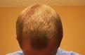 Click image for larger version

Name:	hairloss.jpg
Views:	3266
Size:	82.7 KB
ID:	453940