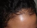 Click image for larger version

Name:	Before Hairline R.jpg
Views:	352
Size:	94.6 KB
ID:	453955