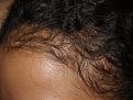 Click image for larger version

Name:	Before Hairline L.jpg
Views:	355
Size:	96.2 KB
ID:	453956