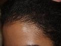 Click image for larger version

Name:	After Hairline L.jpg
Views:	366
Size:	92.6 KB
ID:	453960