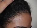 Click image for larger version

Name:	After Hairline R.jpg
Views:	368
Size:	86.6 KB
ID:	453961