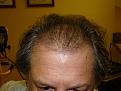 Click image for larger version

Name:	2 weeks post-op 01.jpg
Views:	386
Size:	54.1 KB
ID:	454249