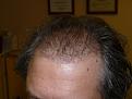 Click image for larger version

Name:	2 weeks post-op 02.jpg
Views:	375
Size:	54.0 KB
ID:	454250