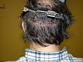 Click image for larger version

Name:	2 weeks post-op 03.jpg
Views:	385
Size:	73.6 KB
ID:	454251