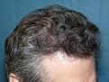 Click image for larger version

Name:	9 months post-op 05.jpg
Views:	376
Size:	83.5 KB
ID:	454256
