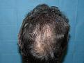 Click image for larger version

Name:	9 months post-op 06.jpg
Views:	410
Size:	61.9 KB
ID:	454257
