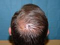 Click image for larger version

Name:	8 months post-op 09.jpg
Views:	440
Size:	61.1 KB
ID:	454325