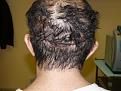 Click image for larger version

Name:	day of surgery 03.jpg
Views:	328
Size:	67.6 KB
ID:	454623