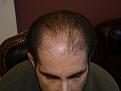 Click image for larger version

Name:	2 months post-op.jpg
Views:	295
Size:	42.4 KB
ID:	454624