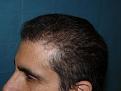 Click image for larger version

Name:	9 months post-op 04.jpg
Views:	303
Size:	52.1 KB
ID:	454628