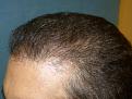 Click image for larger version

Name:	9 months post-op 05.jpg
Views:	311
Size:	72.3 KB
ID:	454629
