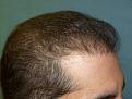 Click image for larger version

Name:	9 months post-op 07.jpg
Views:	313
Size:	61.9 KB
ID:	454631