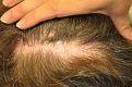 Click image for larger version

Name:	-preop_scar.jpg
Views:	466
Size:	97.7 KB
ID:	454641
