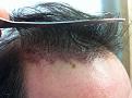 Click image for larger version

Name:	-postopday4_grafts.jpg
Views:	441
Size:	91.8 KB
ID:	454643