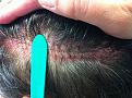 Click image for larger version

Name:	-postopday4_measuredscar.jpg
Views:	479
Size:	95.6 KB
ID:	454647