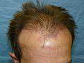 Click image for larger version

Name:	1 day post-op.jpg
Views:	335
Size:	53.1 KB
ID:	454830