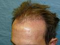 Click image for larger version

Name:	1 day post-op 02.jpg
Views:	322
Size:	51.8 KB
ID:	454831