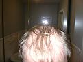 Click image for larger version

Name:	Hair transplant 002.jpg
Views:	421
Size:	88.5 KB
ID:	455453