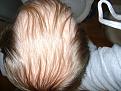 Click image for larger version

Name:	Hair transplant 010.jpg
Views:	395
Size:	96.5 KB
ID:	455454