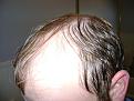 Click image for larger version

Name:	Hair transplant 019.jpg
Views:	403
Size:	94.8 KB
ID:	455455