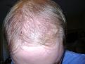Click image for larger version

Name:	Hair transplant 028.jpg
Views:	427
Size:	95.7 KB
ID:	455456
