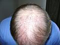 Click image for larger version

Name:	Hair transplant 022.jpg
Views:	443
Size:	95.8 KB
ID:	455458
