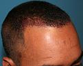 Click image for larger version

Name:	Imed Post-Op-2.jpg
Views:	287
Size:	92.4 KB
ID:	455504