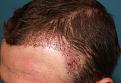 Click image for larger version

Name:	Immed Post op 3.jpg
Views:	363
Size:	95.0 KB
ID:	455556