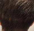 Click image for larger version

Name:	1 month- Scar back.jpg
Views:	998
Size:	36.5 KB
ID:	455626