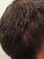 Click image for larger version

Name:	1 month- Scar right side.jpg
Views:	1031
Size:	49.1 KB
ID:	455627