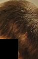 Click image for larger version

Name:	1 months- Scar Left side.JPG
Views:	911
Size:	59.1 KB
ID:	455628