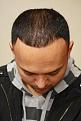 Click image for larger version

Name:	Jorge Moya - 9  month post-op (2).jpg
Views:	551
Size:	86.3 KB
ID:	455682