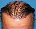 Click image for larger version

Name:	Immed. Post-Op.jpg
Views:	320
Size:	91.3 KB
ID:	455721