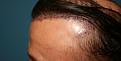 Click image for larger version

Name:	Immed. Post-Op-3.jpg
Views:	329
Size:	90.8 KB
ID:	455723