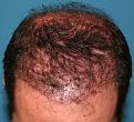 Click image for larger version

Name:	Immed. Post-Op-1.jpg
Views:	343
Size:	89.7 KB
ID:	455954