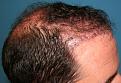 Click image for larger version

Name:	Immed Post-op-2.jpg
Views:	339
Size:	97.0 KB
ID:	455955