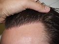 Click image for larger version

Name:	After Hairline.jpg
Views:	537
Size:	95.7 KB
ID:	456140