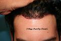 Click image for larger version

Name:	3 day post-op - 1.jpg
Views:	532
Size:	91.4 KB
ID:	456304
