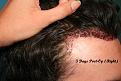 Click image for larger version

Name:	3 day post-op-2 (2)_Copy.jpg
Views:	510
Size:	95.0 KB
ID:	456305