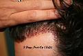 Click image for larger version

Name:	3 days post-op - 4 (4)_Copy.jpg
Views:	654
Size:	94.6 KB
ID:	456306