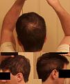 Click image for larger version

Name:	Hairloss.jpg
Views:	661
Size:	67.4 KB
ID:	456311