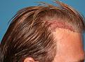 Click image for larger version

Name:	Immed Post-Op-3.jpg
Views:	310
Size:	93.8 KB
ID:	456546