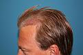 Click image for larger version

Name:	Immed Post-Op-4.jpg
Views:	307
Size:	95.3 KB
ID:	456547