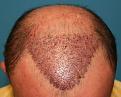 Click image for larger version

Name:	Immed Post-Op - Front.jpg
Views:	328
Size:	90.6 KB
ID:	456871