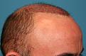 Click image for larger version

Name:	Immed Post-Op - Right.jpg
Views:	307
Size:	87.4 KB
ID:	456872