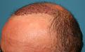 Click image for larger version

Name:	Immed Post-Op - Left.jpg
Views:	329
Size:	93.0 KB
ID:	456873
