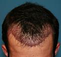Click image for larger version

Name:	Immed Post-Op- Front.jpg
Views:	396
Size:	77.7 KB
ID:	458087