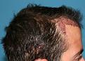 Click image for larger version

Name:	Immed Post-Op - Right.jpg
Views:	359
Size:	89.5 KB
ID:	458088